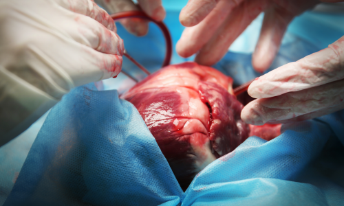 Illustration transplantation cardiaque